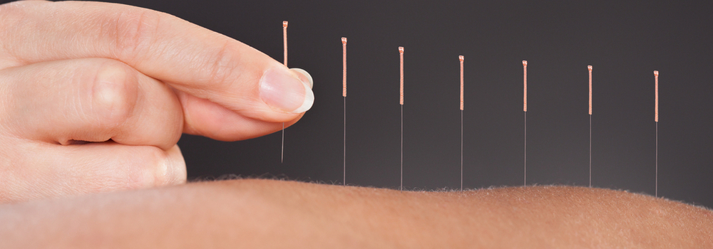 Acupuncture Clonee Perfect Balance